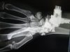 hope-hand-xray.jpg