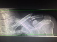 Collarbone.jpg